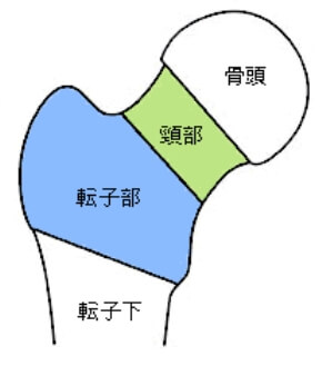 大腿骨近位部骨折の図1
