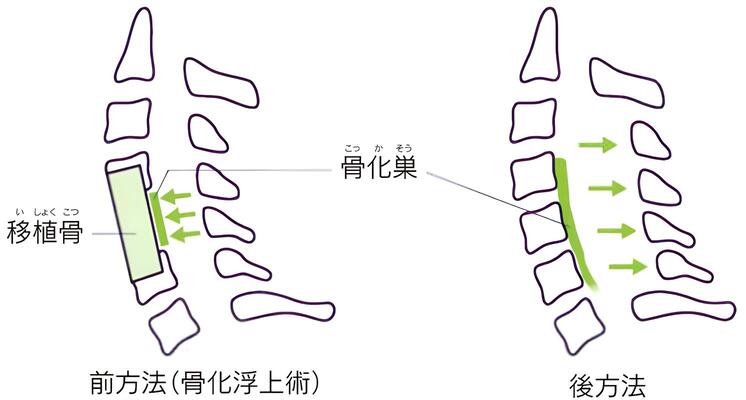 後縦靭帯骨化症の手術