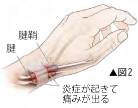 ドゥケルバン腱鞘炎の原因