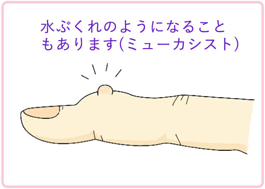 へバーデン結節 症状 水ぶくれ(ミューカシスト)