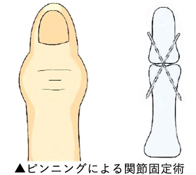 へバーデン結節の治療