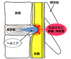 頚椎椎間板ヘルニア