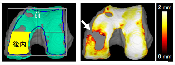 MRI(3D)