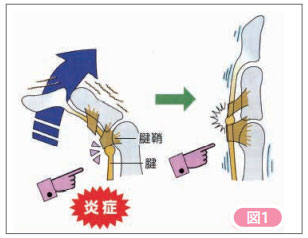 ばね指 腱の炎症図