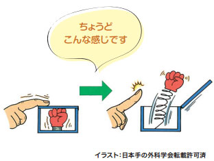 ばね指 イメージ図