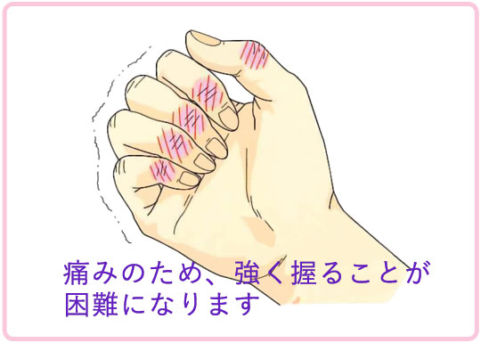の が 関節 腫れる の 手 指