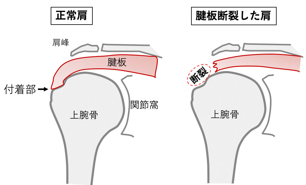 断裂 腱 板 「肩腱板断裂」｜日本整形外科学会 症状・病気をしらべる